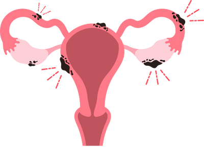 Fibroids, PCOS